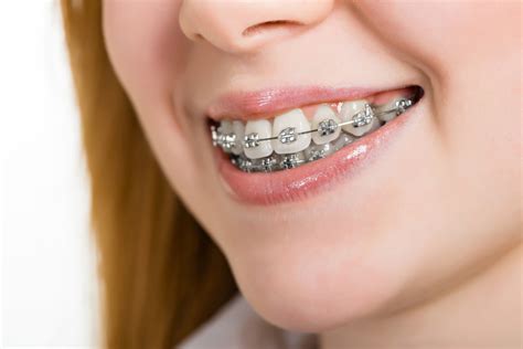 como funcionan los brackets metalicos|brackets de metal.